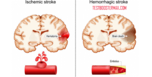 Stroke