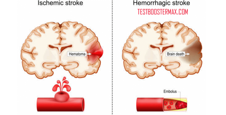 Pengertian dan Penjelasan Lengkap tentang Stroke