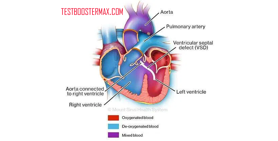 Truncus Arteriosus