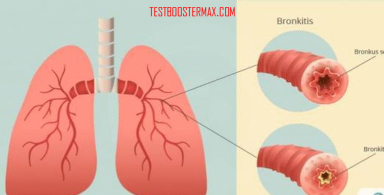 Bronkitis: Peradangan Pada Bronkus yang Mengganggu Sistem Pernapasan