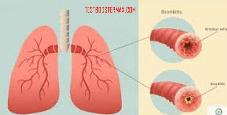 Penyakit Bronkitis Kronis: Pengertian, Penyebab, Gejala, Diagnosis, Pengobatan, dan Pencegahan