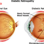 Diabetic Retinopathy: Penyakit Mata yang Menjadi Komplikasi Diabetes