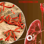 Infeksi Tuberculosis pada Serebellar Pasien Imunokompeten: Tinjauan Klinis dan Diagnostik