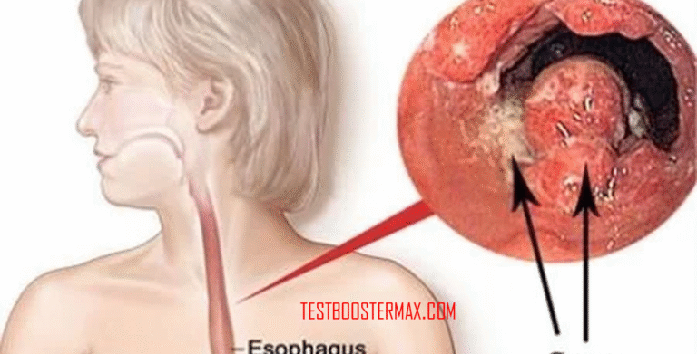 Jenis Kanker Esofagus: Penyakit Mematikan dan Pentingnya Deteksi Dini