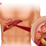 Kanker Liver (Kanker Hati): Penyakit Berbahaya yang Perlu Diketahui