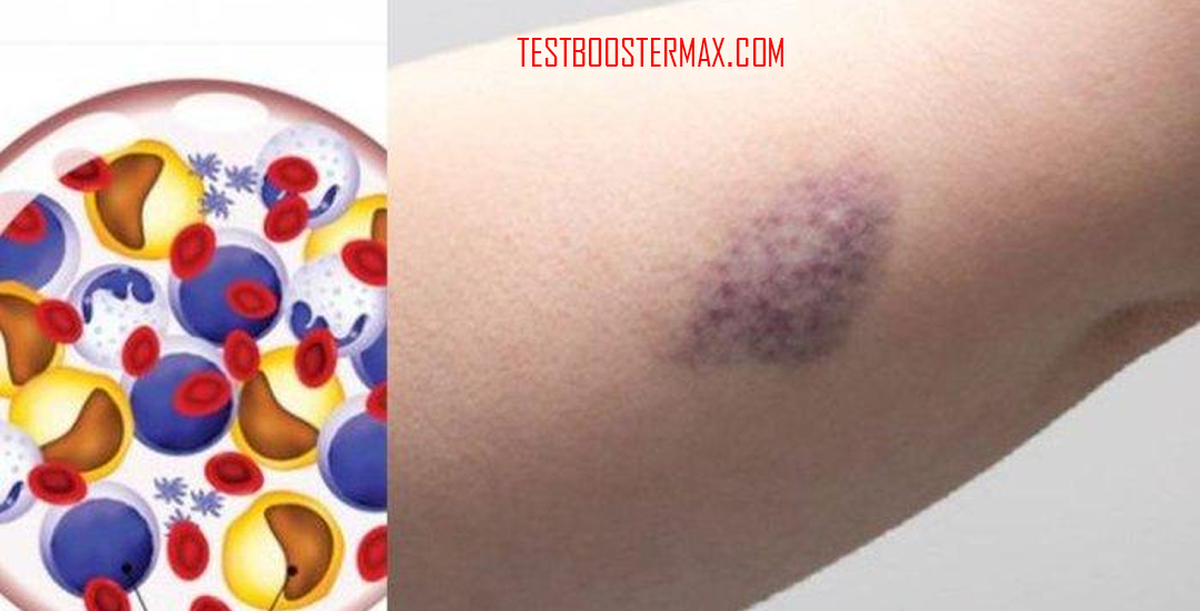 Mengenal Leukemia