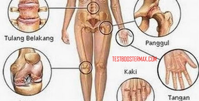 Penyakit Asam Urat (Gout): Penyebab, Gejala, dan Pengobatannya
