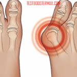 Penyakit Asam Urat (Gout): Penyakit Radang Sendi yang Disebabkan oleh Tingginya Asam Urat