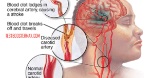 Penyakit Stroke