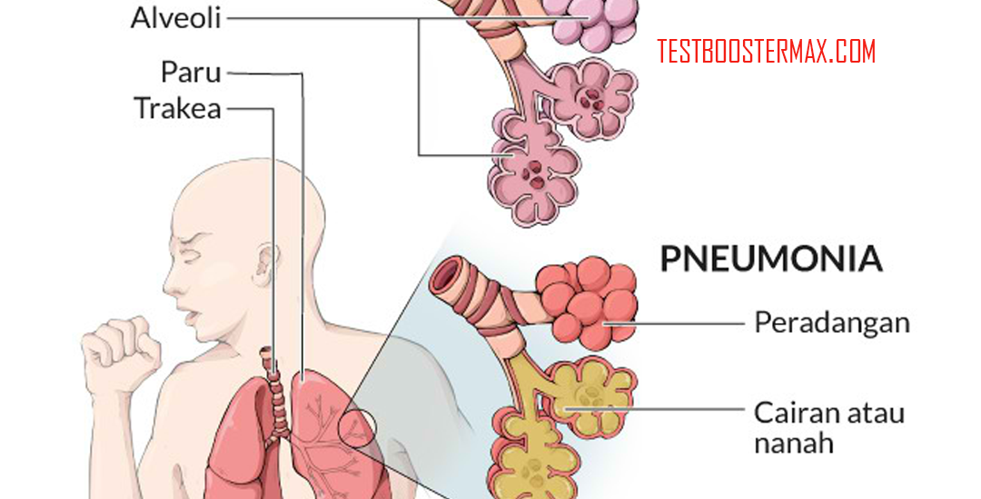 Pneumonia