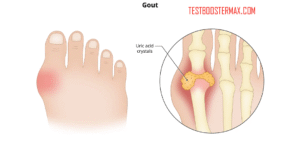 Serangan Gout