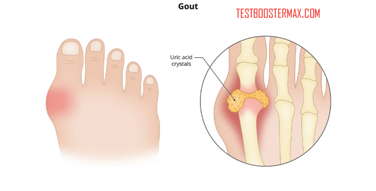 Gejala Awal Serangan Gout: Nyeri Berdenyut dan Sensasi