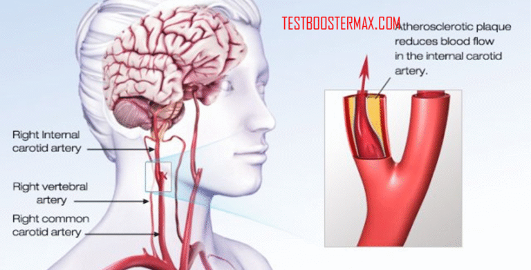 Stroke Serangan Iskemik Transien (Transient Ischemic Attack/TIA)