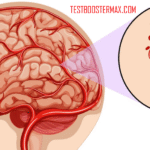 Stroke Perdarahan: Pengertian, Penyebab, Gejala, Diagnosis, Pengobatan, dan Pencegahan