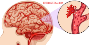 Stroke Perdarahan