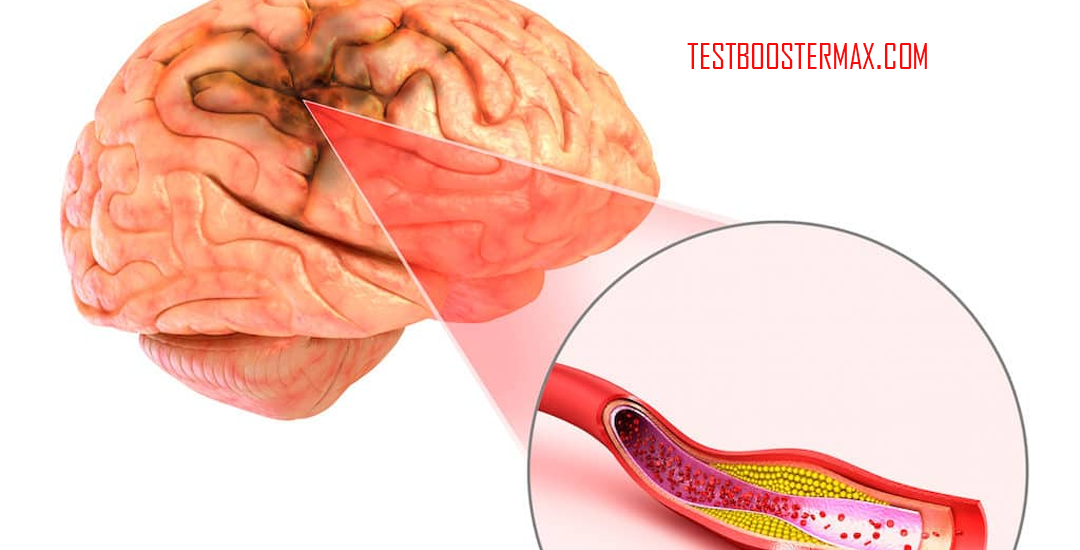 Transient Ischemic