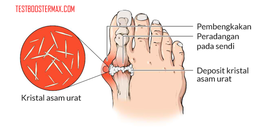 Asam Urat (Gout)