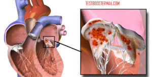 Endokarditis: Penyakit Jantung Berbahaya yang Perlu Diketahui