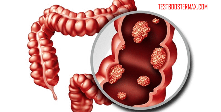 Kanker Kolorektal: Pengertian, Penyebab, Gejala, dan Pengobatan