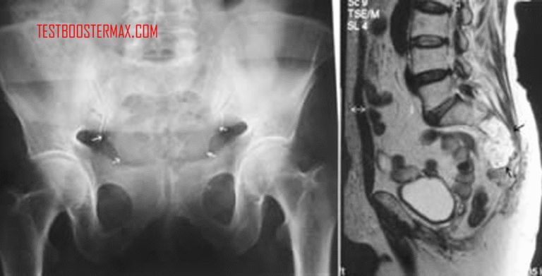 Kordoma adalah Jenis Kanker Tulang Langka yang Berasal dari Sisa Notokorda