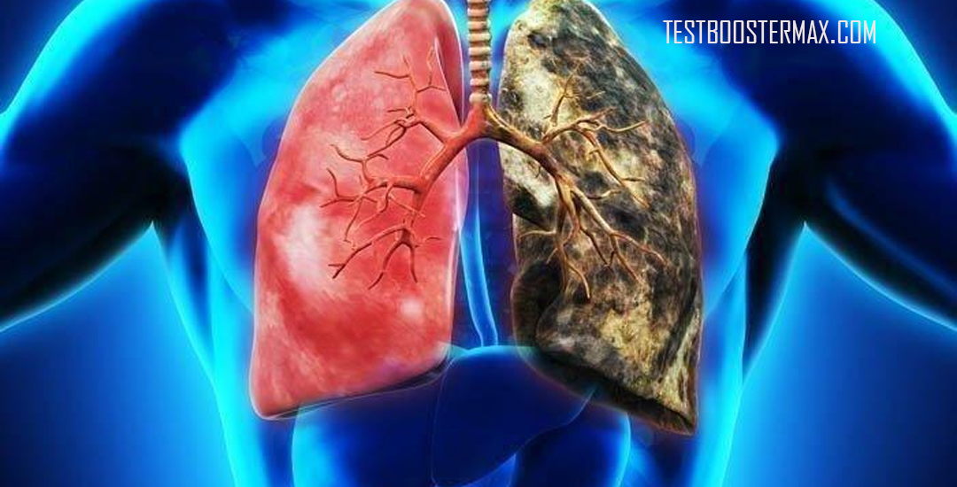 Paru Obstruktif Kronis