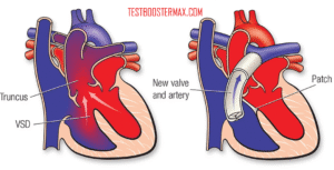 Penyakit Trunkus Arteriosus