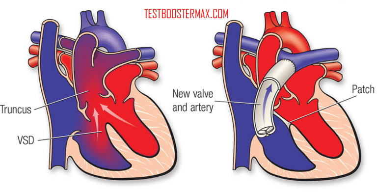 Penyakit Trunkus Arteriosus: Pengertian, Penyebab, Gejala, dan Pengobatan