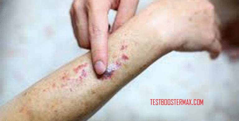 Petechiae: Bintik-bintik Merah Kecil di Bawah Kulit yang Disebabkan oleh Pendarahan