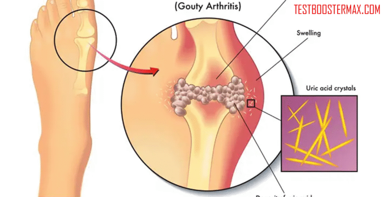 Serangan Gout: Kondisi Paling Umum Akibat Timbunan Asam Urat