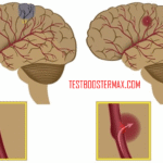 Stroke: Kondisi Darurat Medis yang Perlu Diketahui