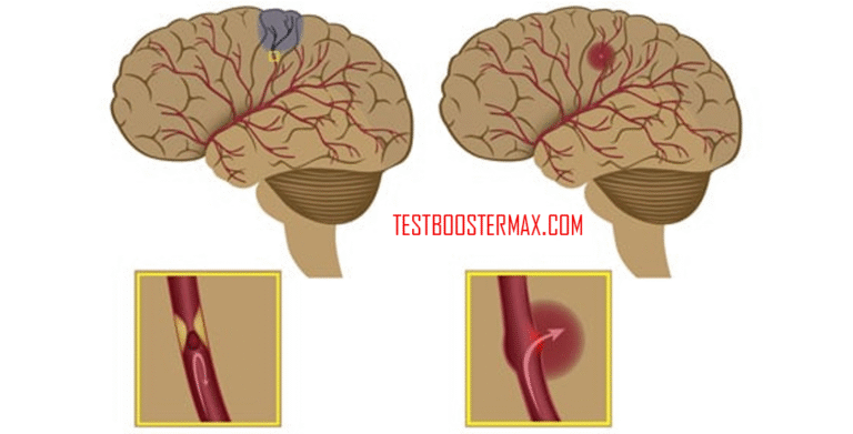 Stroke: Kondisi Darurat Medis yang Perlu Diketahui