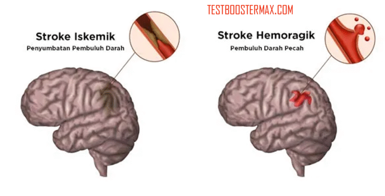 Stroke Hemoragik: Penyebab, Gejala, dan Pengobatannya