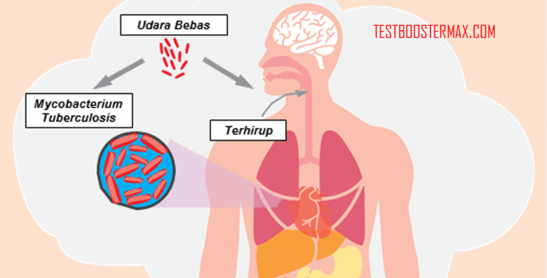 TBC (Tuberkulosis): Penyakit yang Disebabkan oleh Infeksi Bakteri