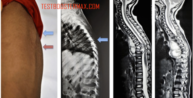 TBC Tulang: Penyakit Menular yang Menyerang Tulang dan Sendi