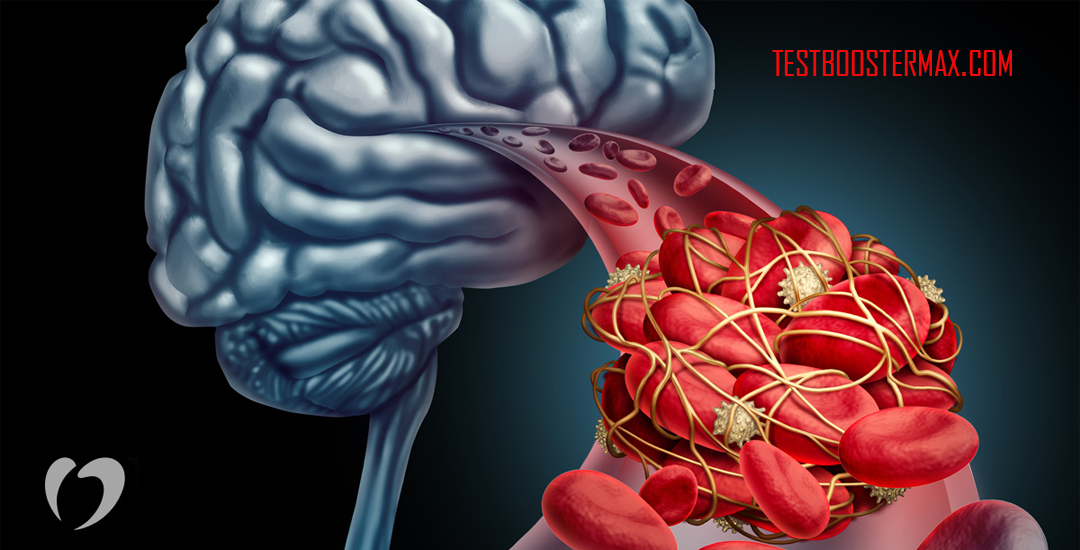 Transient Ischemic Attack