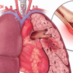 Penyakit Gangguan Sirkulasi Paru-paru: Penyebab, Gejala, dan Pengobatannya
