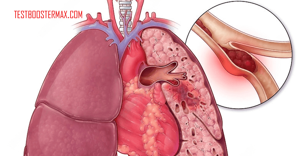 Gangguan Sirkulasi Paru-paru